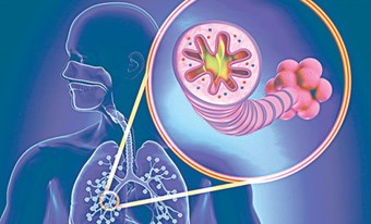 BỆNH VIÊM PHỔI TẮC NGHẼN MÃN TÍNH