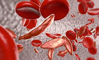 Ngày Thalassemia thế giới năm 2023: Chung tay đẩy lùi bệnh tan máu bẩm sinh vì sức khỏe cộng đồng, vì tương lai nòi giống