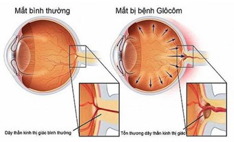 Tuần lễ Bệnh Glôcôm thế giới năm 2025