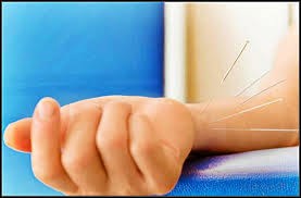 Điều trị liệt dây thần kinh VII ngoại biên bằng châm cứu